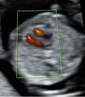 Herz (6 mm breit) mit Darstellung der zwei Herzkammaern im Farbdoppler